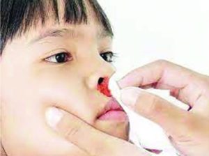 Read more about the article হঠাৎ নাক দিয়ে রক্ত পড়ার কতিপয় কারণ, লক্ষণ, চিকিৎসা ও আমাদের করণীয় ২০২৪